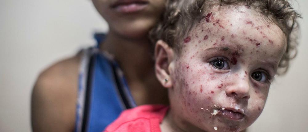 Für viele verletzte Kinder gibt es im Gazastreifen keine Behandlungsmöglichkeiten.
