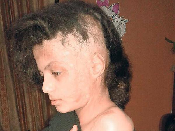 Shams ist elf, sie bekommt dank spezieller medizinischer Verfahren wieder Haare.