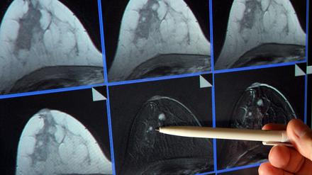 Auf der Bildschirmdarstellung einer Magnetresonanz-(MR)-Mammographie ist ein winziger Tumor in der Brust einer Patientin zu sehen. 