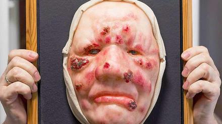 Eine Gesichtsmaske aus Wachs zur Veranschaulichung der Krankheitssymptome im Lepramuseum in Münster (Nordrhein-Westfalen).