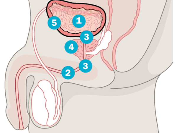 Die Nieren filtern das Blut und produzieren den Urin, mit dem Abfallprodukte aus dem Körper ausgeschieden werden. Der Urin sammelt sich in der Harnblase (1), bevor sich diese über die Harnröhre (2) entleert. Zwei Schließmuskel (3) verhindern, dass dies unkontrolliert geschieht. Unterhalb der Harnblase liegt bei Männern die Prostata (4), die auch einen Teil der Harnröhre umschließt. Die Harnblase ist mit einer Schleimhaut ausgekleidet, Urothel (5) genannt. Rund 90 Prozent der Harnblasenkarzinome entstehen hier.