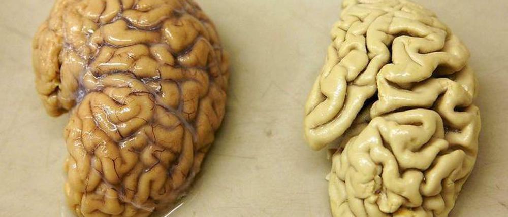 Der Gedächtnisverlust geht mit Nervenschwund einher. Das Hirn von Alzheimer-Patienten (rechts) schrumpft infolge der Erkrankung.