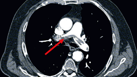Lungenembolien lassen sich mit Hilfe der Computertomographie erkennen. Dabei werden dem Patienten Kontrastmittel in die Blutbahn gespritzt. Wenn das Kontrastmittel dann im CT-Bild von den Lungenarterien nicht wie erwartet zu erkennen ist, deutet das auf ein verschlossenes Blutgefäß hin - eine Lungenembolie.