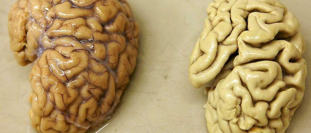 Das Gehirn eines Alzheimer-Patienten ist deutlich geschrumpft.
