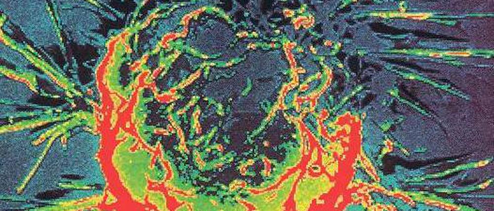 Bösartig. Eine mikroskopische Aufnahme einer Brustkrebszelle (großes Foto). An diesem Tumortyp forscht Robert Weinberg. 