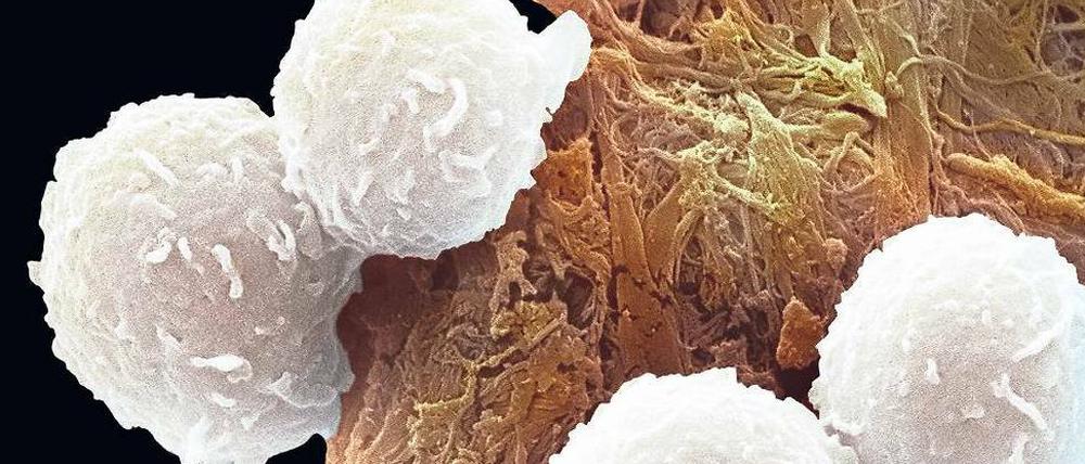 Weiße Gefahr. Krankhaft veränderte weiße Blutzellen eines Leukämiepatienten unter dem Mikroskop (die Abbildung wurde nachträglich koloriert). 