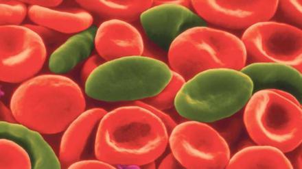 (Nicht-) Korrigieren. Per Gentechnik kann das Gen, das rote Blutkörperchen zu Sichelzellen (grün) macht, korrigiert werden. Doch die Mutation schützt auch vor Malaria. 