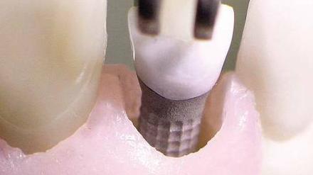 Nahaufnahme eine Zahnimplantats am Kiefermodell.