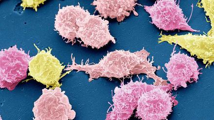 Rasterelektronenmikroskopische Aufnahme von Krebszellen. In ihnen hat die Erbgut-Korrektur versagt. 
