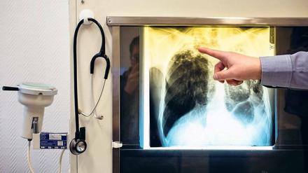 Gefährlich. Wenn Flecken auf der Lunge erkennbar sind, ist die Tuberkulose schon fortgeschritten. Eine frühzeitige Diagnose könnte eventuell die Therapie erleichtern.