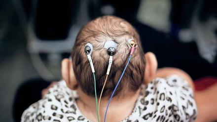 Am Kopf eines Babys mit einem kleinen Kopf sind drei Elektroden befestigt.