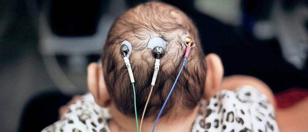 Am Kopf eines Babys mit einem kleinen Kopf sind drei Elektroden befestigt.