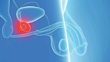 Verborgen. Die von Nervenbahnen durchzogene Prostata liegt unter der Harnblase. Eine Entfernung der Drüse hat oft Impotenz oder Inkontinenz zur Folge.