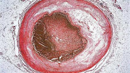 Gefäßschaden. Die mikroskopische Aufnahme zeigt den Querschnitt einer Schlagader (Arterie). Sie wurde durch Verfettung verengt (weißes Material) und schließlich durch einen Blutpfropf (Thrombus) verschlossen.