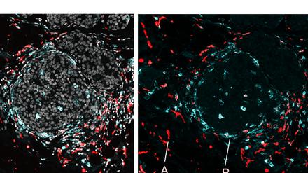 Immunzellen des Makrophagen-Typs, links das Immunsystem behindernd, rechts aktiv in der Bekämpfung von Maus-Tumor-„Nestern“