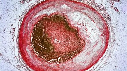 Eingeengt. Bei einer Thrombose gerinnt Blut an der Gefäßwand, wie hier in einer Herzkranzarterie.