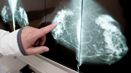Blick von oben. Die klassische Mammografie bietet nur eine Draufsicht auf die Brust. In dem 2-D-Bild können sich verschiedene Strukturen überlagern und eine Wucherung vortäuschen.