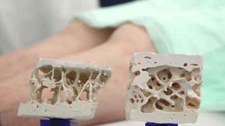 Wenn die knochenbildenden Zellen nicht mehr genug Skelettmasse aufbauen, dann verwandelt sich das stabile Gewebe (rechts) kaum merklich über die Jahre zu einem ein porösen, leicht brüchigen Knochenrest (links).