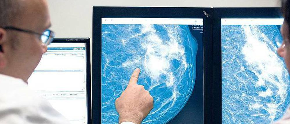 Hyperthermie wirkt nachweislich auch bei Brustkrebs - hier eine Mammographie.