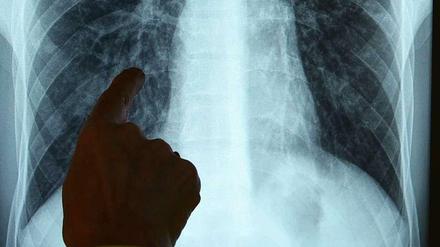 In Steglitz-Zehlendorf ist ein Lehrer an offener Tuberkulose erkrankt. Ein Röntgenbild zeigt eine erkrankte Lunge.