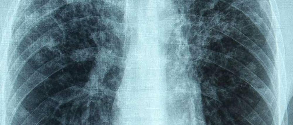 In Steglitz-Zehlendorf ist ein Lehrer an offener Tuberkulose erkrankt. Ein Röntgenbild zeigt eine erkrankte Lunge.