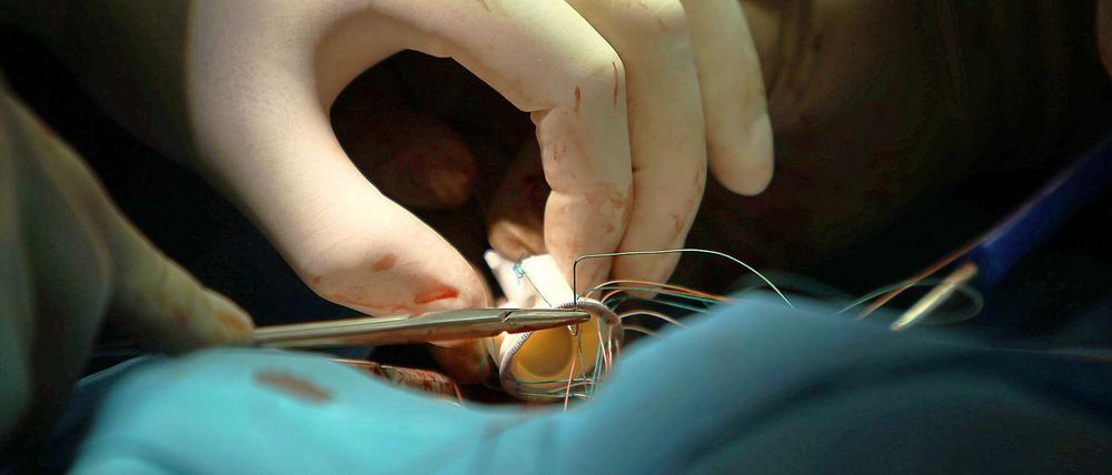 Ein Chirurg bei einer Herzoperation. Wie groß ist das Risiko?