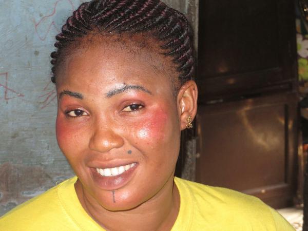 Anu Julius, 29, ist Friseurin in Lagos, Nigeria. Nachdem sie eine Creme zum Bleichen der Haut verwendete, muss sich einen Schirm gegen die Sonne benutzen. 