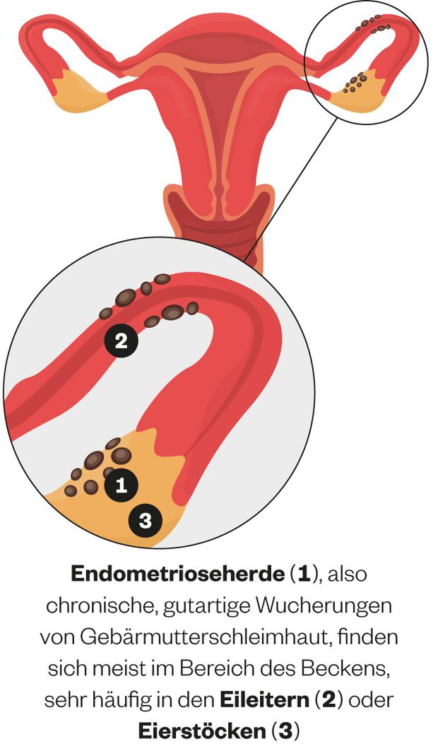 Schmerzen durch verirrtes Gebärmuttergewebe Millionen Frauen leiden unter Endometriose