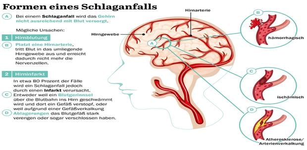 Hirninfarkt Durch Embolie Zerebraler Arterien
