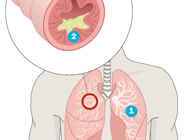 Die COPD ist eine chronische Entzündung der unteren Atemwege (1). In den entzündeten und verengten Bronchien (2) setzt sich zäher Schleim ab - Hustenattacken und schwere Luftnot sind die Folge.
