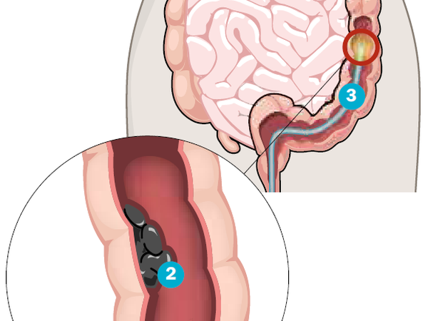 Die Schleimhaut des Dickdarms (1) istanfällig für Tumore (2). Bei einer Darmspiegelung sucht der Arzt mit einem Endoskop (3) nach Krebs oder dessen Vorstufen (Polyp) (4) und entfernt diese. Sind sie dafür bereits zu groß, muss operiert werden.