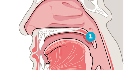 Die Gaumenmandeln (1) sitzen am Übergang von Mundhöhle zum Rachen. Entzündete und geschwollene Mandeln führen zu Schluck- und Atembeschwerden.