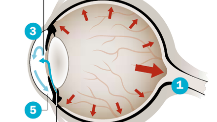Die ungesund hohe Belastung (rote Pfeile) vor allem für den Sehnerven (1) entsteht, weil kontinuierlich im Auge gebildetes Kammerwasser (2) nicht mehr ungehindert abfließen kann. Diese Flüssigkeit, die unter anderem die Hornhaut (3) mit Nährstoffen versorgt, wird im Ziliarkörper (4) in der hinteren Augenkammer gebildet und normalerweise über den Schlemm'schen Kanal (5), einen kleinen Abfluss in der vorderen Augenkammer, wieder abtransportiert. Zur Behandlung eignen sich zunächst Medikamente, die den Kammerwasserabfluss verbessern oder die Kammerwasserproduktion hemmen.