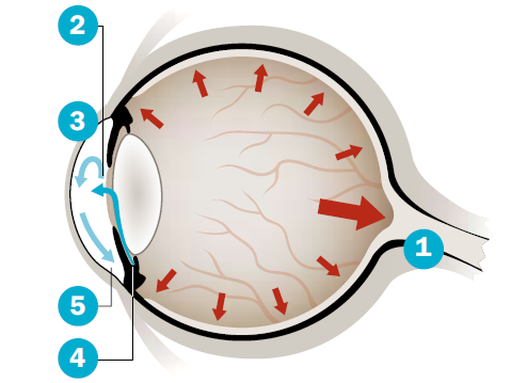 Glaukom - Ursachen, Symptome und Therapie