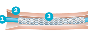 Ein Katheter (1) ist ein Kunststoffschlauch, spaghettidünn und bis zu 1,50 Meter lang. Er wird über die Hauptschlagader (Aorta) in die Herzkranzgefäße (2) - auch Koronararterien genannt - vorgeschoben. Über diesen Zugang kann der Arzt ein Kontrastmittel spritzen, durch das die Gefäße auf einem Röntgenbild sichtbar werden - und auch die Engstellen (3) in ihnen. Um den Katheter herum befindet sich ein Ballon, über dem ein geschlossener Stent (weißes Gitter) liegt.