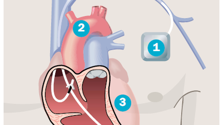 Der Herzschrittmacher (1) wird meist knapp unter dem Schlüsselbein unter die Haut gesetzt. Über eine Vene (2) gelangen die Elektrodenkabel zum Herzen (3), werden dort im Muskel verankert.