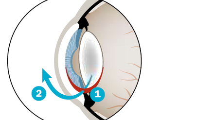 Bei der Operation wird die getrübte Linse durch eine künstliche ersetzt. Dazu wird ein Schnitt (1) am Übergang von der Horn- zur Lederhaut gesetzt. In diese Öffnung wird ein spezielles Ultraschallgerät eingeführt, mit dem der Linseninhalt zerkleinert und abgesaugt wird (2). In den leeren Kapselsack wird die gefaltete Ersatzlinse geschoben, die sich dort entfaltet (3).