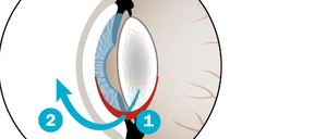 Bei der Operation wird die getrübte Linse durch eine künstliche ersetzt. Dazu wird ein Schnitt (1) am Übergang von der Horn- zur Lederhaut gesetzt. In diese Öffnung wird ein spezielles Ultraschallgerät eingeführt, mit dem der Linseninhalt zerkleinert und abgesaugt wird (2). In den leeren Kapselsack wird die gefaltete Ersatzlinse geschoben, die sich dort entfaltet (3).