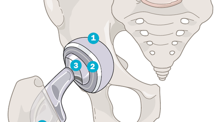 Eine Hüftprothese ersetzt das verschlissene Gelenk und besteht aus vier Komponenten: Die Gelenkpfanne wird durch eine hohle Halbkugel (1) aus Titan ersetzt, die mit einem Kunststoff- oder Keramik-Inlay (2) ausgekleidet ist und die Funktion des Knorpels übernimmt. Den Oberschenkelkopf ersetzt eine Gelenkkugel (3), die mit einem Schaft (4) in den Oberschenkel verspannt oder einzementiert wird.