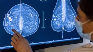 Medizinisches Personal untersucht mit einer Mammografie die Brust einer Frau auf Brustkrebs. Die Untersuchung soll bei der frühen Erkennung von Brustkrebs helfen.