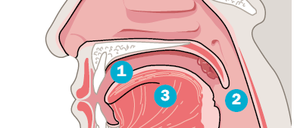 Die Mund- (1) und Rachenhöhle (2) sind vollständig mit Schleimhaut ausgekleidet. Darin finden sich zahlreiche kleine Schleim- und Speicheldrüsen. Zudem ist die Mundhöhle besonders stark mit Nervengewebe durchdrungen. Bösartige Tumore können überall auf den Schleimhäuten im Mund entstehen, beispielsweise auf der Lippe, der Innenseiteder Wangen oder auf der Zunge (3).