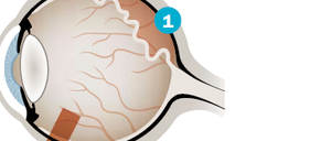 Bei einer fortgeschrittenen Netzhautablösung (1) wird der Glaskörper entfernt (2), die die Netzhaut wegdrückende Flüssigkeit abgesaugt und der Augeninnenraum danach mit einem speziellen Gas oder Öl gefüllt, um die abgelöste Netzhaut von innen wieder an die Augenhinterwand anzudrücken (3). Zum Fixieren kommen dann Laser oder Kältesonden zum Einsatz.