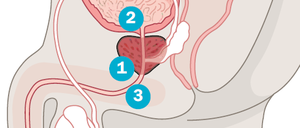 Die Prostata (1) ist eine etwa kastaniengroße Drüse, die unterhalb der Harnblase (2) sitzt und einen Teil der Harnröhre (3) umschließt. Bei vielen Männern beginnt das Organ allerdings im Alter aus unerfindlichen Gründen zu wachsen. Das wuchernde Drüsengewebe engt die Harnröhre ein und drückt auf den Blasenboden. Die Folgen: Schwierigkeiten beim Wasserlassen, schmerzhafter Harndrang, Blasenkrämpfe.