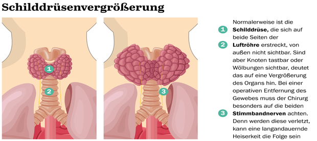 Wie Schnell Wachsen Knoten In Der Schilddrüse ger.animalia-life.club