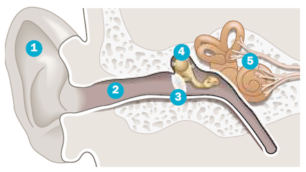 Schallwellen werden über die Ohrmuschel (1) und den äußeren Gehörgang (2) bis zum Trommelfell (3) geleitet. Dessen Schwingungen bewegen die Gehörknöchelchen (4), wodurch Vibrationen die Hörschnecke und den Hörnerven (5) im Innenohr erreichen.
