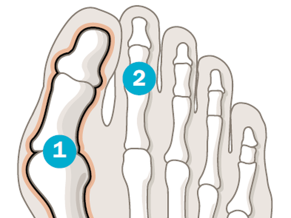 Hallux valgus Informationen rund um die Zehenfehlstellung