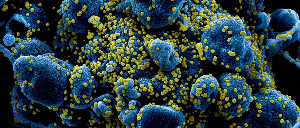 Befallene Zellen (blau) produzieren neue Viruspartikel (gelb).