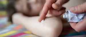 Neurodermitis ist die häufigste chronische Hauterkrankung im Kindesalter.