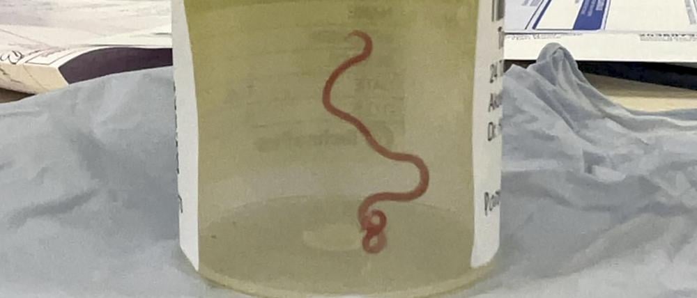 In einem Krankenhaus in Canberra haben Ärzte einen lebendigen, acht Zentimeter langen Rundwurm aus dem Gehirn einer 64-jährigen Frau entfernt.