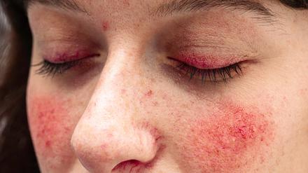 Weil Rosacea mitten im Gesicht auftritt und sich nur mühsam verbergen lässt, leiden viele Betroffene auch seelisch.